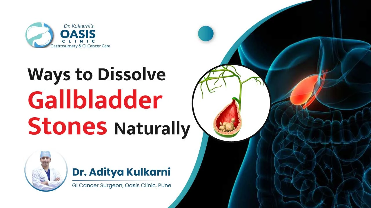Ways to Dissolve Gallbladder Stones Naturally