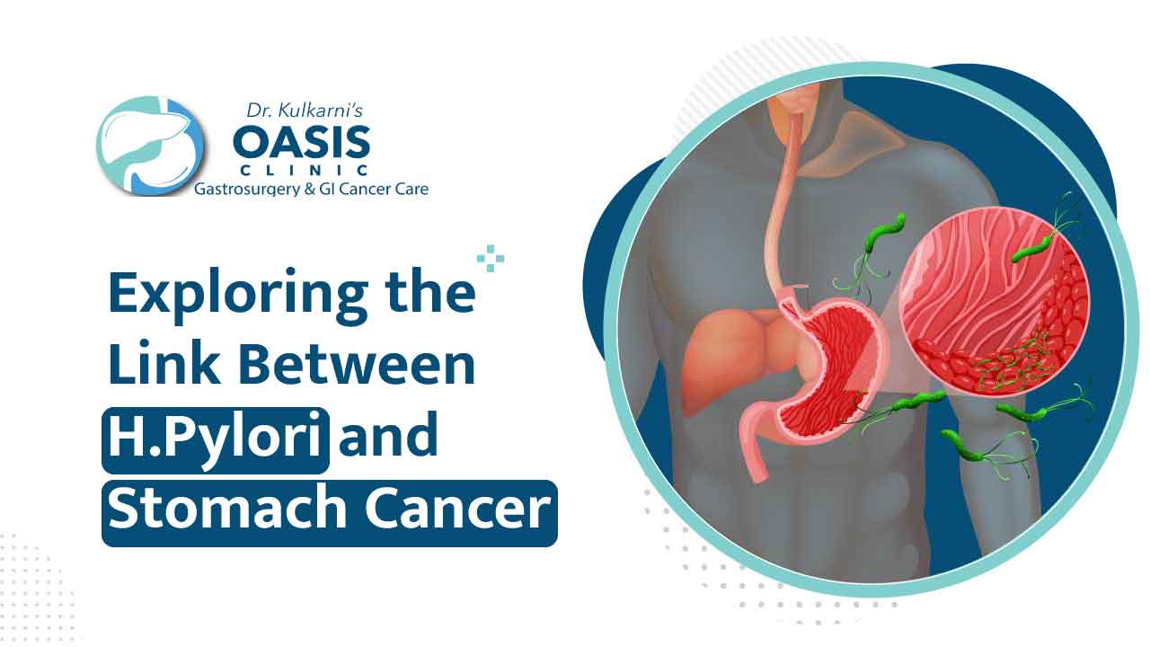 Exploring the Link Between H.Pylori and Stomach Cancer