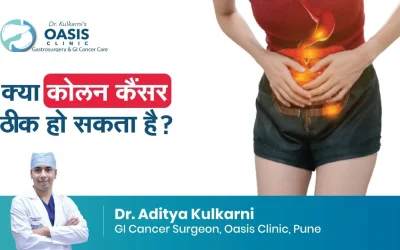 Is Colon Cancer Curable?