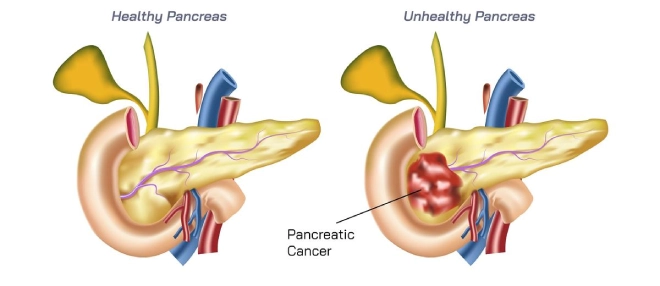 Pancreas cancer stage
