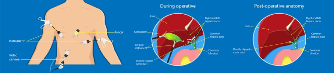 Laparoscopic surgery