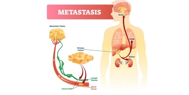 Metastasis