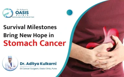 Survival Milestones Bring New Hope in Stomach Cancer