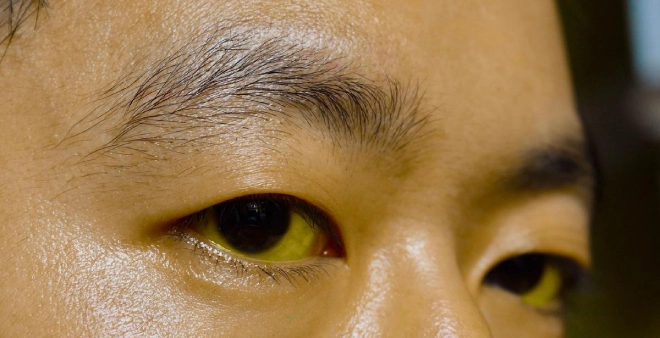 Jaundice eyes Jaundice eyes