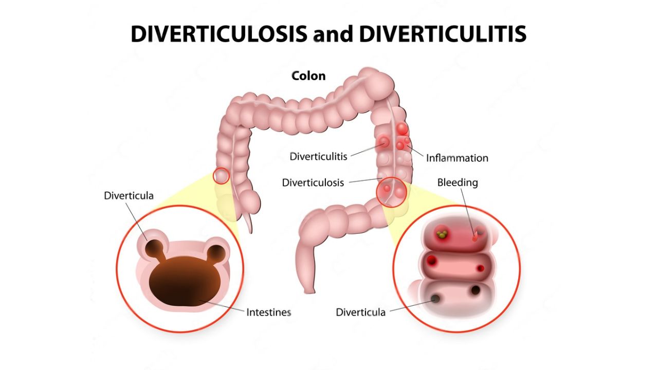 Diverticulitis vs Diverticulosis What's the Difference