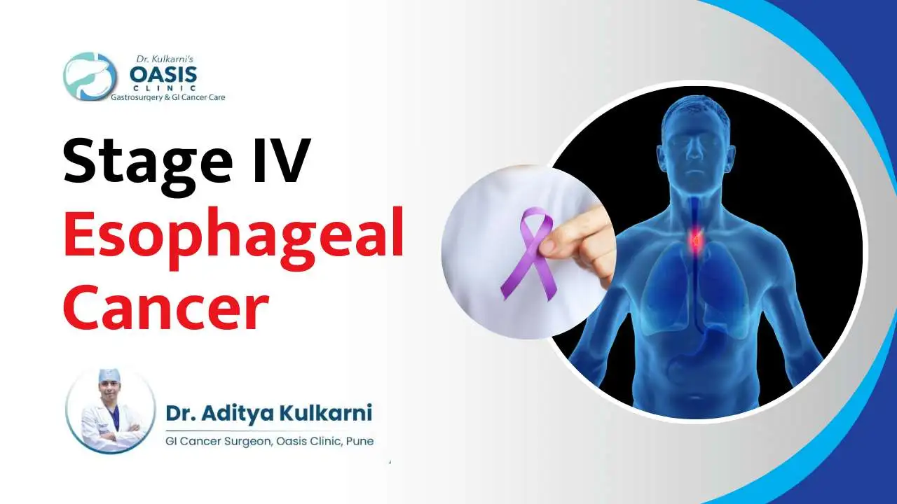 Stage IV Esophageal Cancer