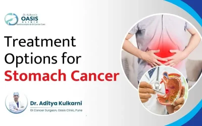 Treatment Options for Stomach Cancer