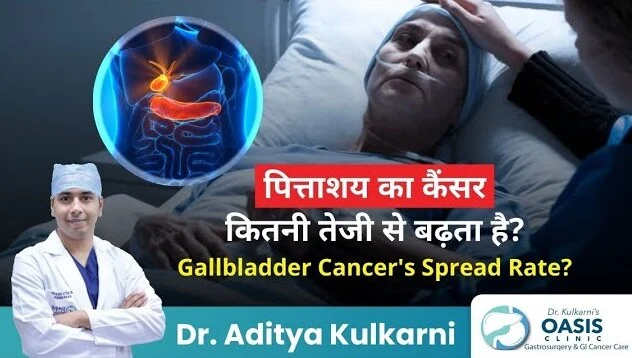 how fast does gallbladder cancer spread?