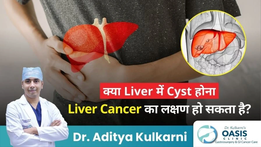 can liver cyst be a sign of liver cancer?