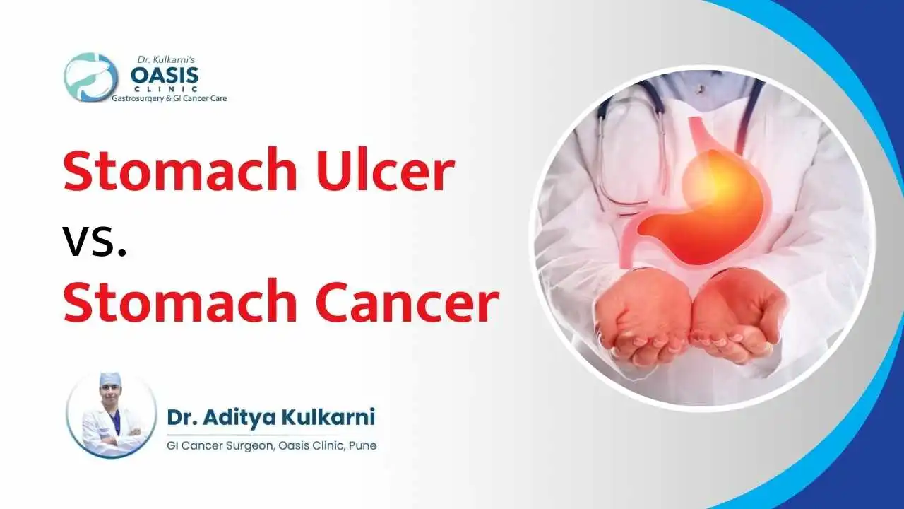 Stomach Ulcer vs. Stomach Cancer