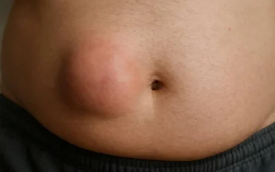 Direct vs. Indirect Hernia: Understanding the Differences