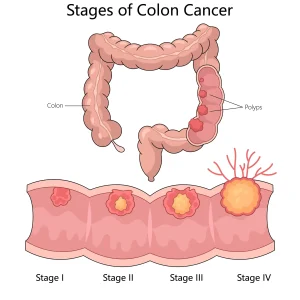 stages of colon cancer