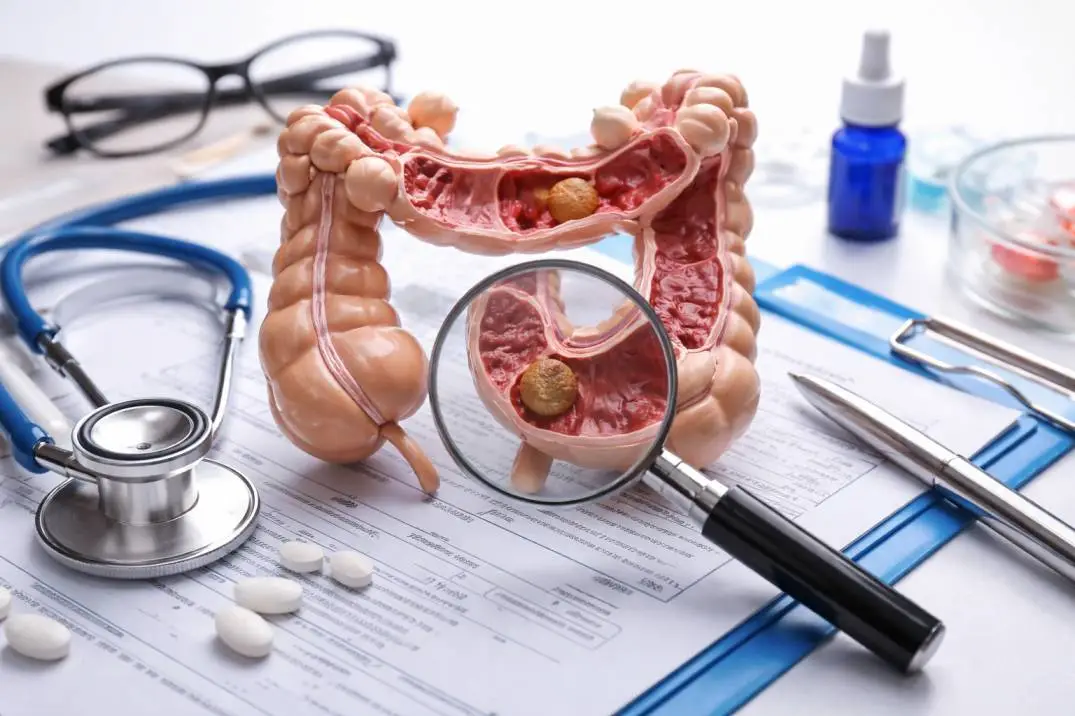 Stage 1 Colorectal Cancer Survival Rate