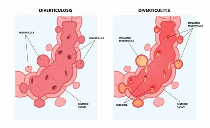 Diverticulitis vs. Ulcerative Colitis: 5 Differences To Know